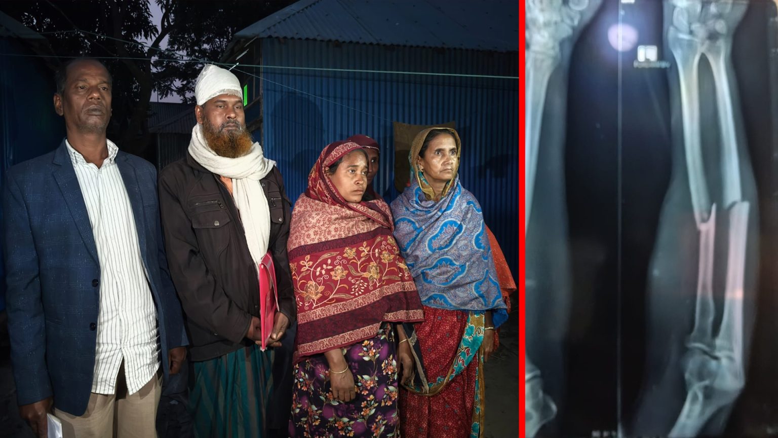 নবীনগরে বিয়াইয়ের হাত ভেঙে দিল বিয়ান সাহেব, নারীসহ একাধিক ব্যক্তি আহত