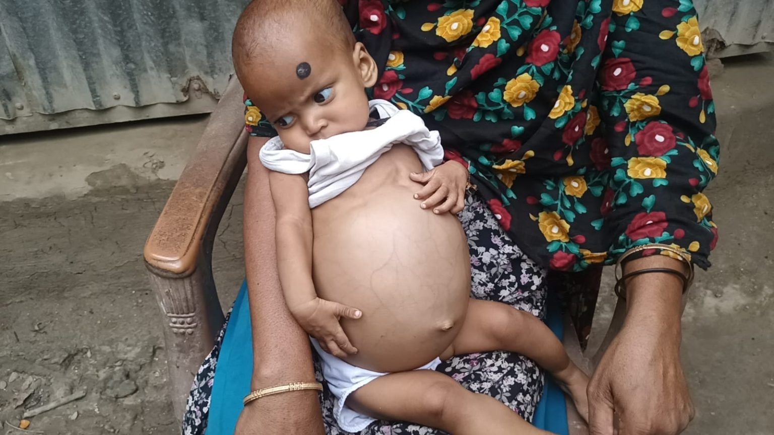 মোল্লাহাটে অসহায় শিশুর জীবন বাঁচাতে মানবিক সহায়তার আকুতি
