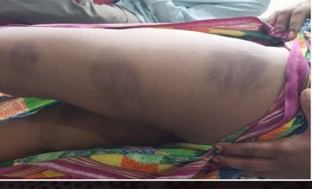 ঝিকরগাছায় হাফেজী মাদ্রাসার ছাত্রকে নির্মমভাবে প্রহারের অভিযোগ।অভিযুক্ত শিক্ষকের শাস্তি দাবি